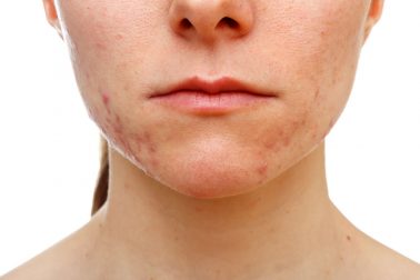 Biểu hiện của gan bị nóng Biểu hiện của gan bị nóng