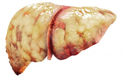 Gan nhiễm mỡ Gan nhiễm mỡ