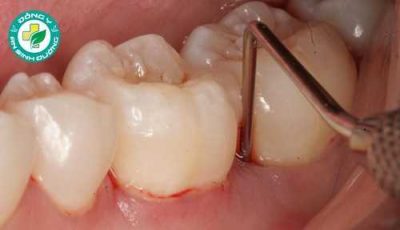 Viêm lợi là gì? Làm sao để phòng tránh viêm lợi?