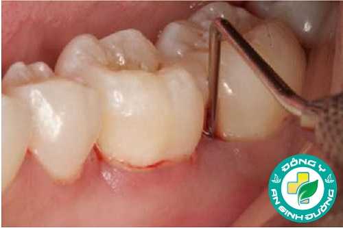 Viêm lợi có thể gây ra sưng tấy và đau nhức