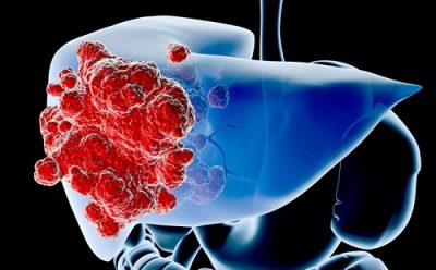 Ung thư gan – Nguyên nhân, triệu chứng và cách phòng ngừa