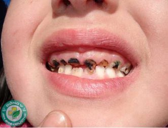 Sâu răng – Nguyên nhân và cách phòng ngừa