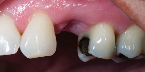 Mất răng do biến chứng viêm tủy răng