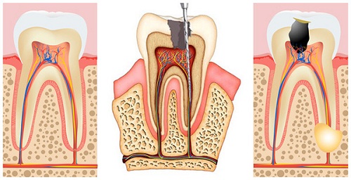 Sưng lợi do viêm tủy răng