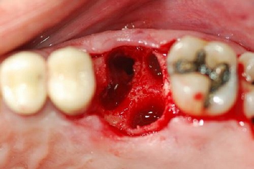 Viêm tủy răng do tổn thương từ sâu răng