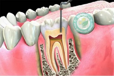 Viêm tủy răng và những biến chứng nguy hiểm