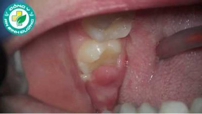 Viêm lợi trùm và những biến chứng nguy hiểm