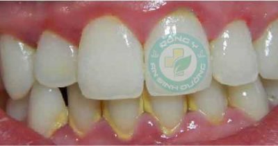 Cao răng và tác hại tới răng miệng