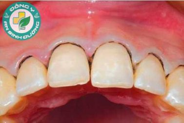 Viêm chân răng: Nguy cơ mất răng tiềm ẩn 