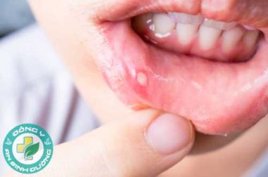 Bị nhiệt miệng phải làm sao?