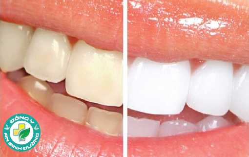 Răng trắng tự nhiên và răng bị ố