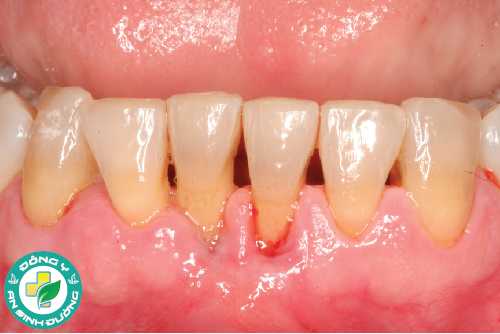 Có mối liên hệ giữa bệnh nướu răng và bệnh Alzheimer hay không