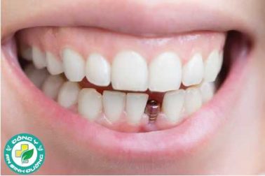 Nguyên nhân nào khiến bạn bị răng lung lay?