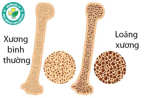 Mật độ xương quanh răng giảm đi có thể dẫn đến răng lung lay