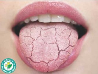 Chứng khô miệng và vai trò của nước bọt
