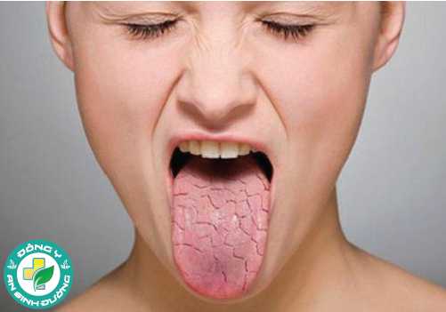Khô miệng có thể làm tăng nguy cơ mắc các bệnh răng miệng