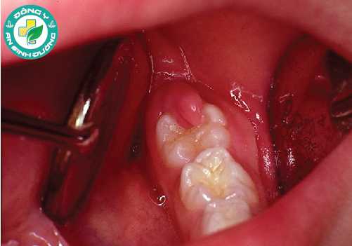 Viêm lợi trùm là một biến chứng rất phổ biến khi mọc răng khôn