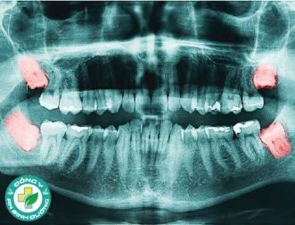 Mọc răng khôn và các biến chứng nguy hiểm