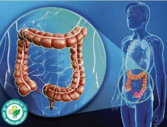 Vi khuẩn ở miệng làm cho ung thư đại trực tràng tiến triển nhanh hơn?