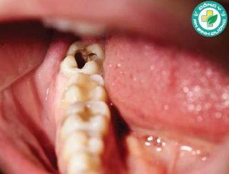 10 điều bạn nên làm để ngăn ngừa sâu răng