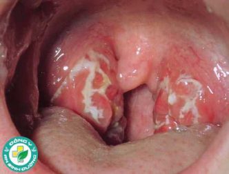 7 dấu hiệu bạn có thể bị viêm họng liên cầu khuẩn