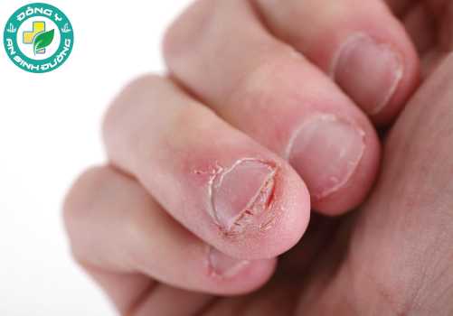 Cắn móng tay có thể khiến các vi khuẩn hoặc nấm xâm nhập vào cơ thể và máu