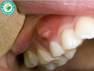 Áp xe nướu: Nguyên nhân, triệu chứng và điều trị