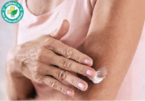 Giữ ẩm cho da là một trong những cách đơn giản nhất để ngăn chặn ngứa do vẩy nến