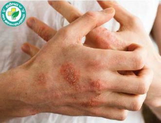 9 cách để kiểm soát ngứa do vẩy nến