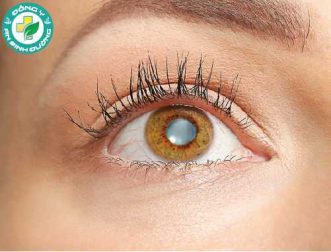 7 dấu hiệu thầm lặng của đục thủy tinh thể
