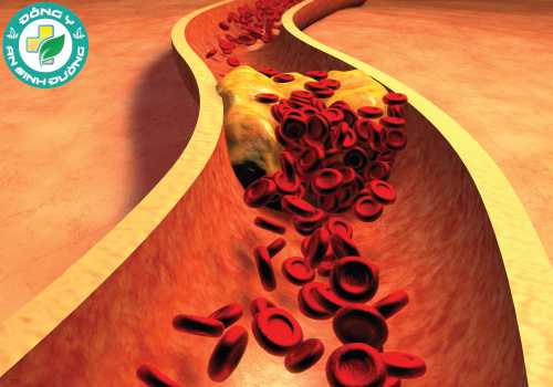 Cholesterol cao là nguyên nhân hàng đầu gây ra các bệnh tim mạch như tăng huyết áp