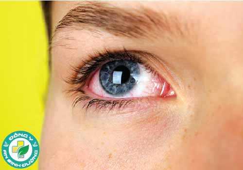 Bệnh khô mắt ảnh hưởng từ 5% đến 34% dân số toàn cầu