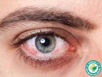 Bệnh khô mắt: Điều trị mới dựa vào kháng thể