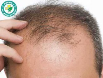 Ô nhiễm không khí có thể dẫn đến rụng tóc như thế nào?