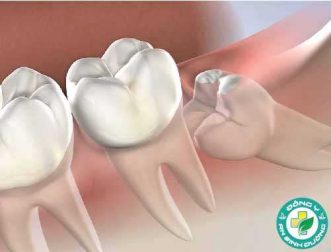 Độ tuổi mọc răng khôn là bao nhiêu?