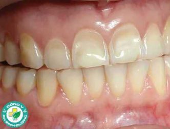 Mòn men răng: Những điều bạn nên biết