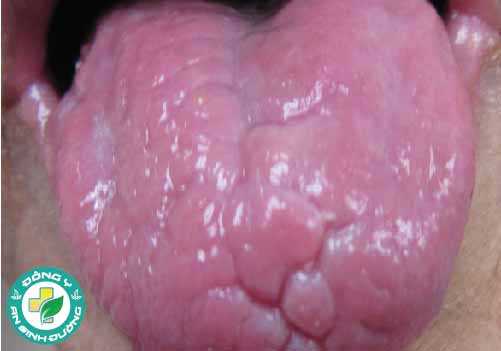 Bệnh celiac có thể khiến bạn mất đi những sợi lông nhỏ trên bề mặt lưỡi