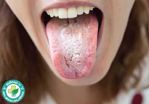 Bệnh tưa lưỡi thường là kết quả của một hệ thống miễn dịch bị suy yếu