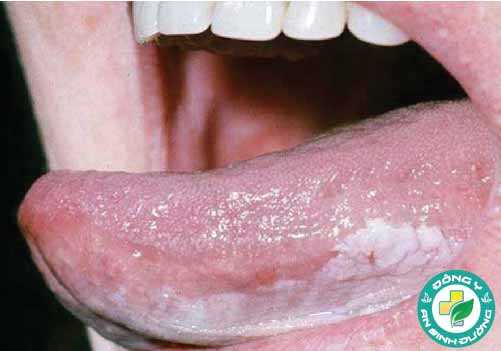 Các mảng trắng trên lưỡi có thể là kết quả của ung thư