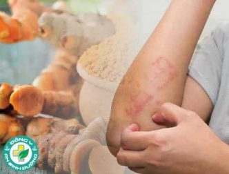 Nghệ có thể giúp chống lại bệnh chàm?