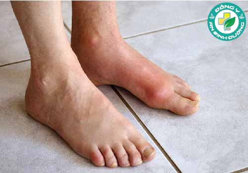 Nếu không điều trị, bệnh gút có thể lan sang các khớp khác trong cơ thể, ở cả chi trên và chi dưới