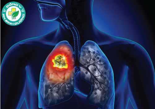 Ung thư phổi là một trong những loại ung thư phổ biến nhất
