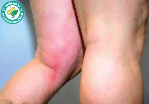 Đau, sưng ở chân có thể là dấu hiệu của cục máu đông ở tĩnh mạch chính ở chân